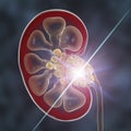 Kidney stones treatment. Lithotripsy