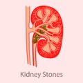 Kidney stones medical concept organ  crystaline mineral formations cross section kidney for  medical  education flat vector  illus Royalty Free Stock Photo