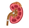 Kidney stones medical concept vector . anatomy