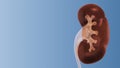 Human Kidney stones medical concept