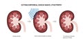 Lithotripsy procedure concept