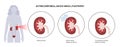 Lithotripsy procedure concept