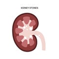 Kidney stones treatment