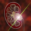 Kidney stones treatment. Lithotripsy