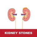 Kidney stones vector illustration