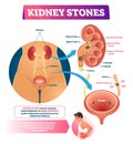 Kidney stones vector illustration. Labeled internal hard deposits disease.