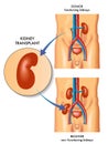 Kidney Transplant