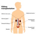 Kidney Transplantation Royalty Free Stock Photo