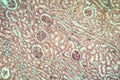 Kidney tuberculosis Diseased tissue Royalty Free Stock Photo