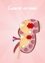 Kidneys Cancer