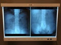 Kidneys X-ray On A Lght Box.