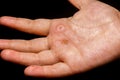 Kids eczema hand palm Royalty Free Stock Photo