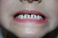 Kids teeths - closeup look