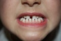 Kids teeths - closeup look