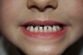 Kids teeths - closeup look