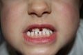 Kids teeths - closeup look