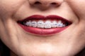Kissable lips, white teeth, and braces Royalty Free Stock Photo