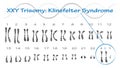 klinefelter syndrome karyotype vector illustration XXY Trisomy Royalty Free Stock Photo