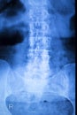 Kneck and spine injury x-ray scan Royalty Free Stock Photo