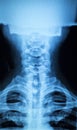 Kneck and spine injury x-ray scan Royalty Free Stock Photo
