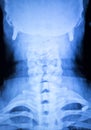 Kneck and spine injury x-ray scan Royalty Free Stock Photo