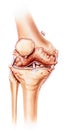 Knee - Advanced Osteoarthritis, Front View Royalty Free Stock Photo