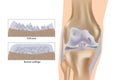 Medical vector illustration with damaged knee structure and healthy knee comparison. Knee arthrosis.