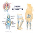 Knee bursitis condition with fluid filled bursa in leg joint outline diagram