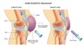 Knee bursitis drainage procedure