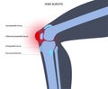 Bursitis inflammation concept