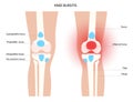 Bursitis inflammation concept