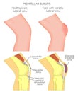 Knee bursitis_Prepatellar bursitis