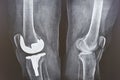 Knee cap replacement xrays. Titanium implant. Osteoarthritis. Anatomy