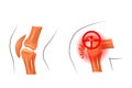 Knee, dislocation, fracture. traumatology and orthopedics