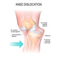 Knee dislocation. Royalty Free Stock Photo