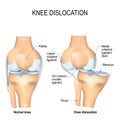 Knee dislocation and normal. Royalty Free Stock Photo