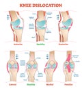 Knee Dislocations - medical vector illustration diagrams. Anatomical knee injury types scheme.