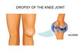 knee hydrarthrosis, articular dropsy Royalty Free Stock Photo