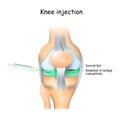 Knee Injections Royalty Free Stock Photo