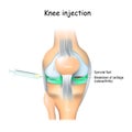 Knee Injections