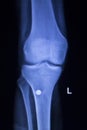 Knee injury implant xray scan Royalty Free Stock Photo