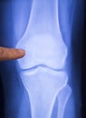 Knee injury surgical xray scan Royalty Free Stock Photo