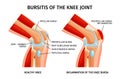 Knee Joint Bursitis Infographics