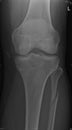 Knee joint with fibular fracture