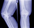 Knee joint inflammation.Osteoarthritis OA knee . film x-ray Royalty Free Stock Photo