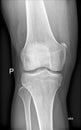 Knee joint medical Xray