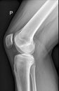 Knee joint medical Xray