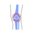 Knee joint pain