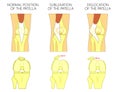 Knee joint problem_Dislocation of the patella