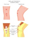 Knee joint problem_Patellar tendonitis or jumper knee. Front and lateral views